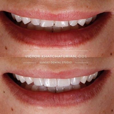 Gallery Before & After Gallery - Patient 4387422 - Image 1