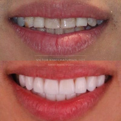 Gallery Before & After Gallery - Patient 4387423 - Image 1
