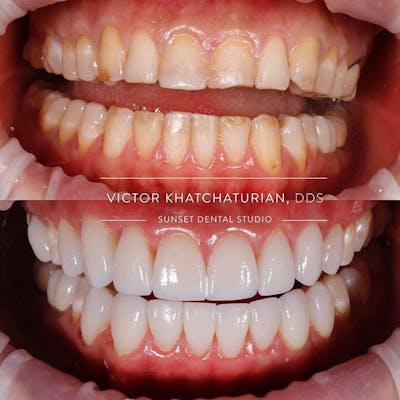 Gallery Before & After Gallery - Patient 4387424 - Image 1