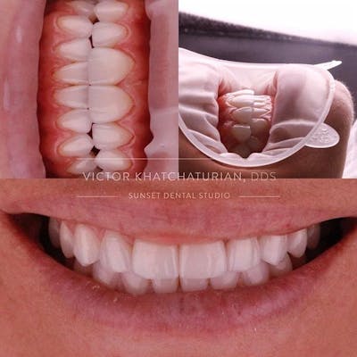 Gallery Before & After Gallery - Patient 4387426 - Image 1