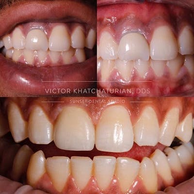 Gallery Before & After Gallery - Patient 4387432 - Image 1