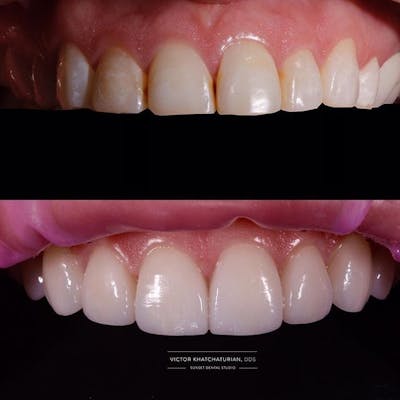 Gallery Before & After Gallery - Patient 4387434 - Image 1