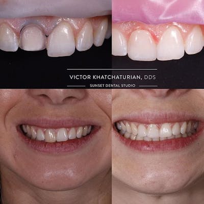 Gallery Before & After Gallery - Patient 4387435 - Image 1