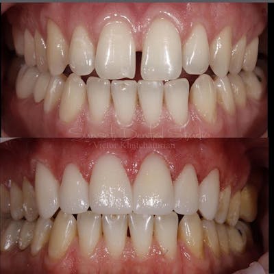 Gallery Before & After Gallery - Patient 4387440 - Image 1