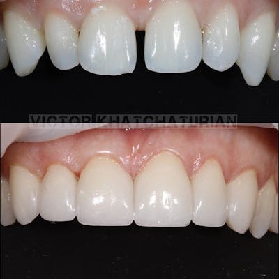 Gallery Before & After Gallery - Patient 4387441 - Image 1
