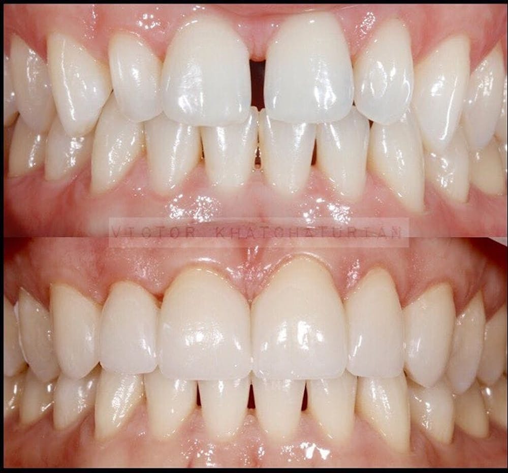 Gallery Before & After Gallery - Patient 4387442 - Image 1