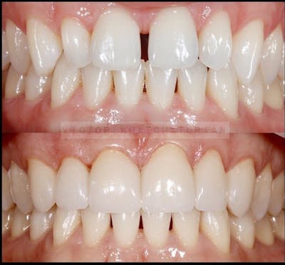 Gallery Before & After Gallery - Patient 4387442 - Image 1
