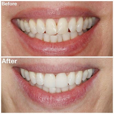 Gallery Before & After Gallery - Patient 4387443 - Image 1
