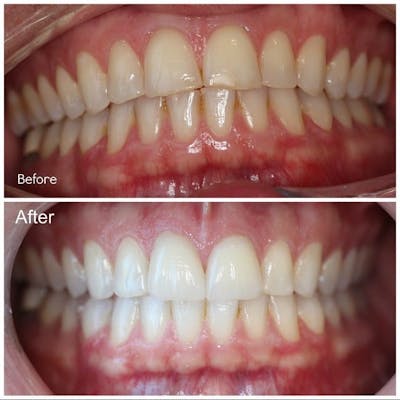 Gallery Before & After Gallery - Patient 4387444 - Image 1