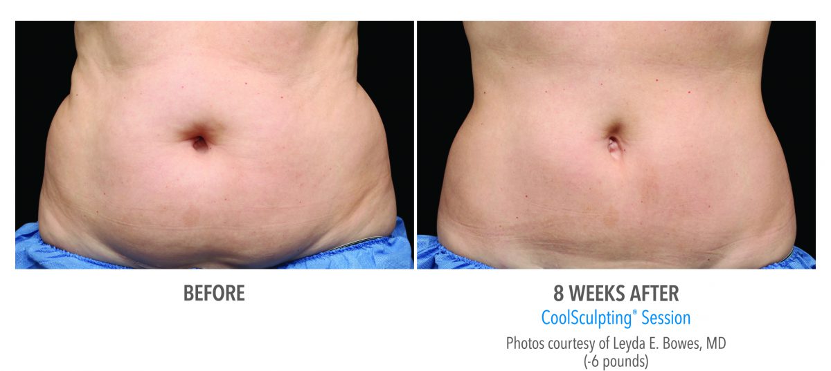 Before and after coolsculpting