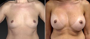 Breast Augmentation