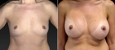 Breast Augmentation Before & After Gallery - Patient 4416062 - Image 1