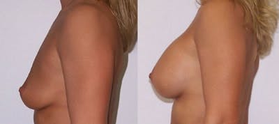 Breast Augmentation Before & After Gallery - Patient 4566933 - Image 1