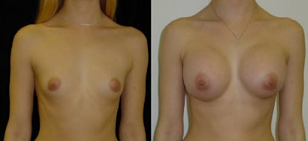 Breast Augmentation Before & After Gallery - Patient 4566934 - Image 1