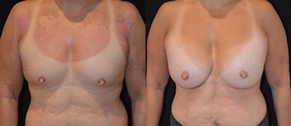 Breast Augmentation Before & After Gallery - Patient 4566935 - Image 1