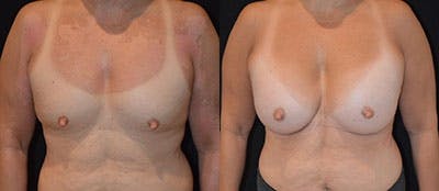 Breast Augmentation Before & After Gallery - Patient 4566935 - Image 1