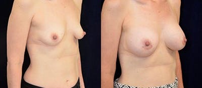 Breast Augmentation Before & After Gallery - Patient 4566936 - Image 1