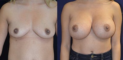 Breast Augmentation Before & After Gallery - Patient 4566937 - Image 1