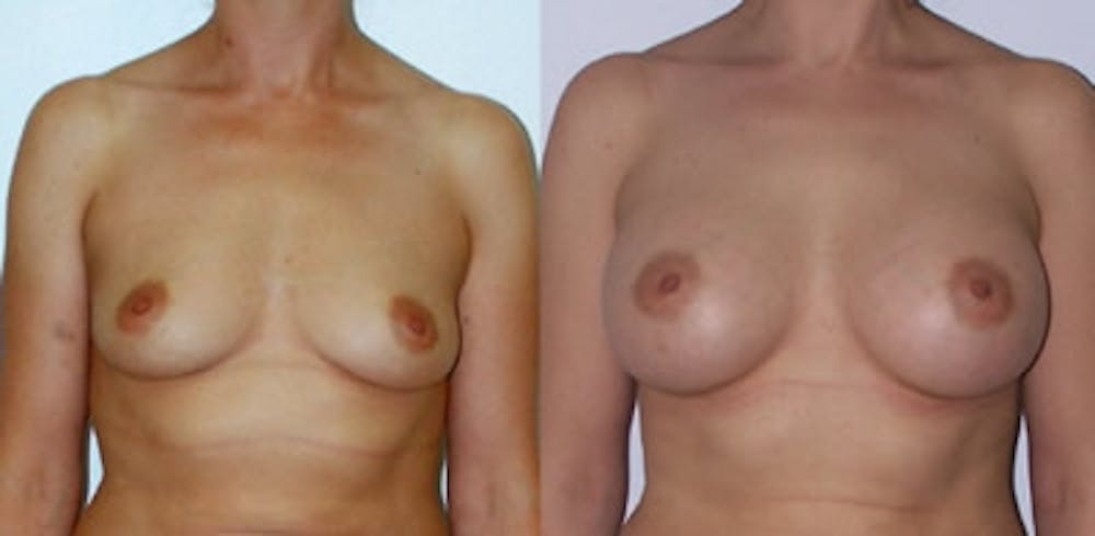 Breast Augmentation Before & After Gallery - Patient 4566938 - Image 1