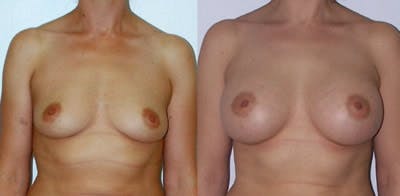 Breast Augmentation Before & After Gallery - Patient 4566938 - Image 1