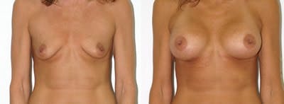 Breast Augmentation Before & After Gallery - Patient 4566939 - Image 1