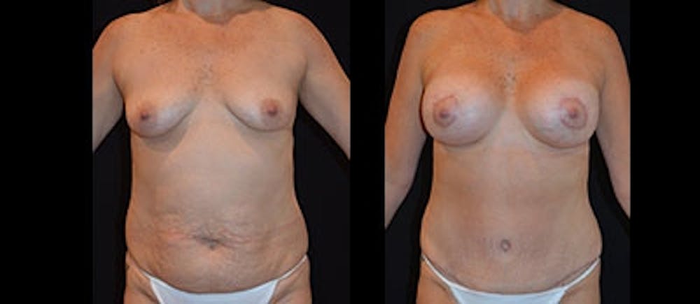 Breast Augmentation Gallery - Patient 4566940 - Image 1