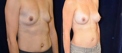 Breast Augmentation Before & After Gallery - Patient 4566941 - Image 1