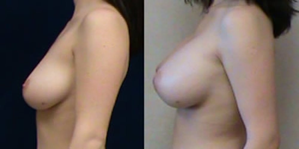 Breast Augmentation