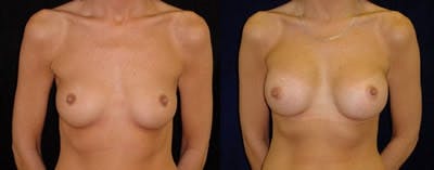 Breast Augmentation Before & After Gallery - Patient 4566955 - Image 1