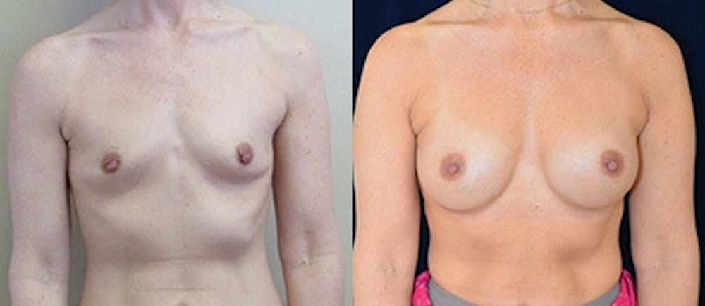 Breast Augmentation Before & After Gallery - Patient 4566956 - Image 1