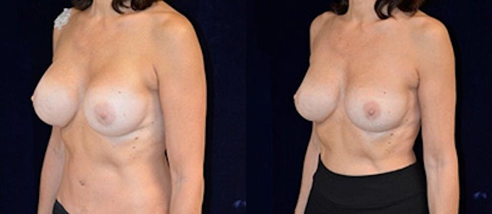 Breast Augmentation Before & After Gallery - Patient 4566957 - Image 1