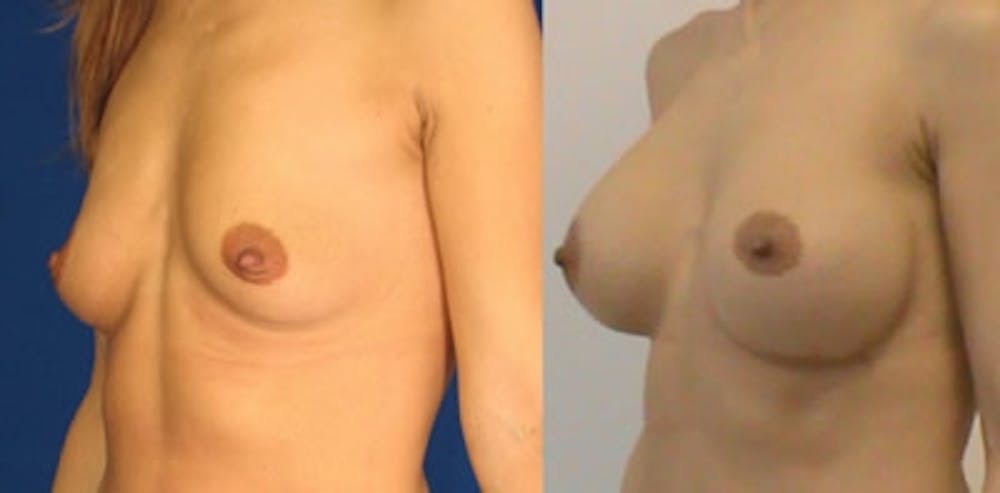 Breast Augmentation Gallery - Patient 4566958 - Image 1
