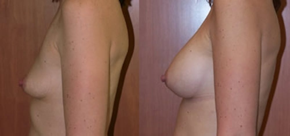 Breast Augmentation Before & After Gallery - Patient 4566959 - Image 1