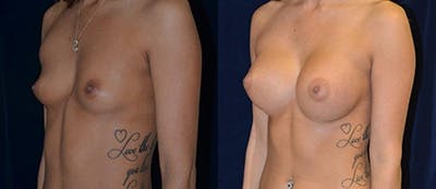 Breast Augmentation Before & After Gallery - Patient 4566960 - Image 1