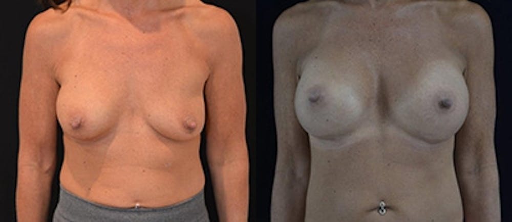 Breast Augmentation Before & After Gallery - Patient 4566961 - Image 1
