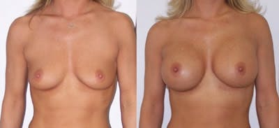 Breast Augmentation Before & After Gallery - Patient 4566962 - Image 1