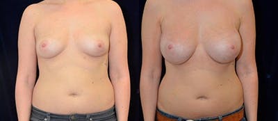 Breast Augmentation Before & After Gallery - Patient 4566964 - Image 1