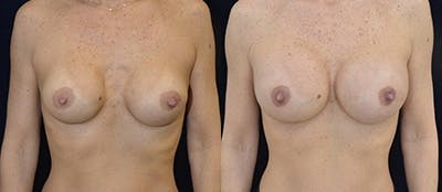 Breast Augmentation Before & After Gallery - Patient 4566965 - Image 1