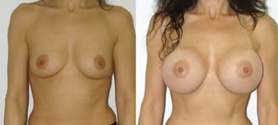 Breast Augmentation Before & After Gallery - Patient 4566966 - Image 1