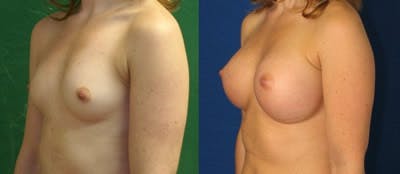 Breast Augmentation Before & After Gallery - Patient 4566967 - Image 1
