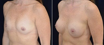 Breast Augmentation Before & After Gallery - Patient 4566968 - Image 1