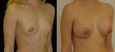 Breast Augmentation Before & After Gallery - Patient 4566970 - Image 1