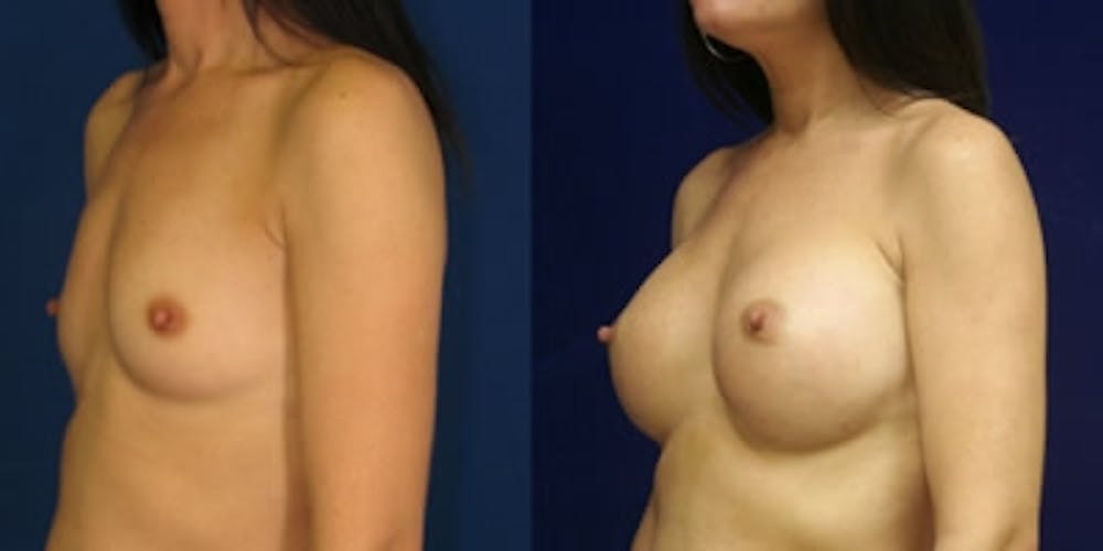 Breast Augmentation Before & After Gallery - Patient 4566971 - Image 1