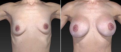 Breast Augmentation Before & After Gallery - Patient 4566972 - Image 1