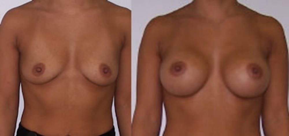 Breast Augmentation Before & After Gallery - Patient 4566974 - Image 1