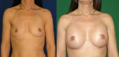Breast Augmentation Before & After Gallery - Patient 4566975 - Image 1
