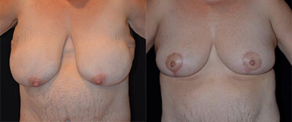 Breast Reduction Before & After Gallery - Patient 4566977 - Image 1