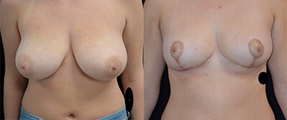 Breast Reduction Before & After Gallery - Patient 4566978 - Image 1