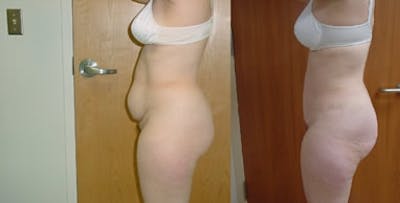 Abdominoplasty Before & After Gallery - Patient 295642 - Image 1