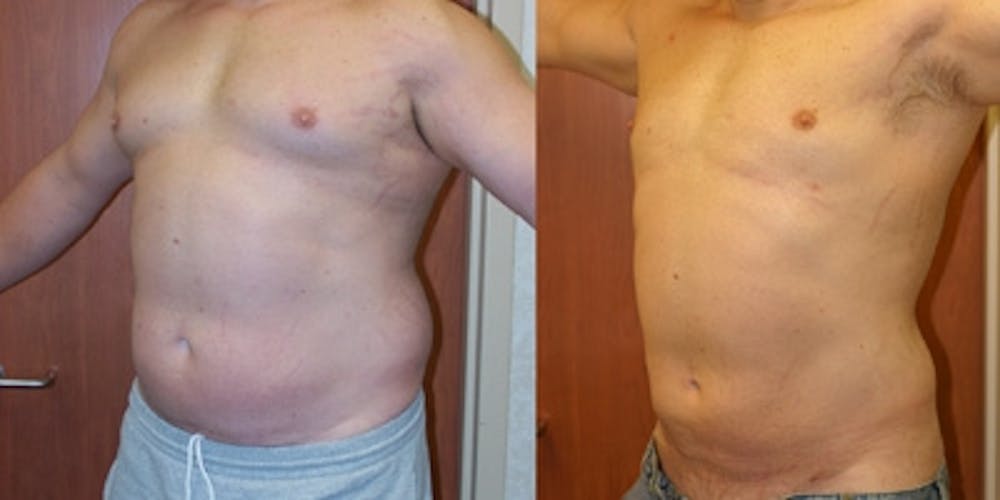 Liposuction Before & After Gallery - Patient 120710 - Image 1